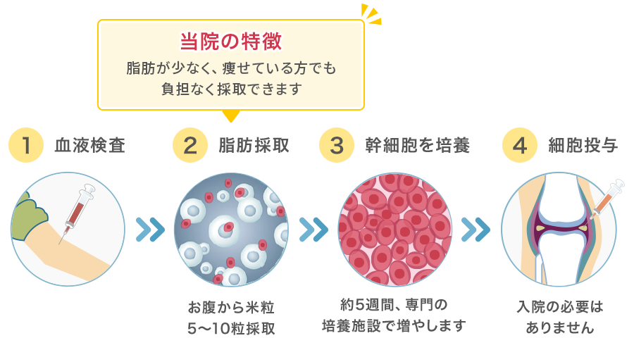 ①血液検査→②脂肪採取（お腹から米粒5〜10粒採取）【当院の特徴】脂肪が少なく、痩せている方でも負担なく採取できます→③幹細胞を培養（約5週間、専門の培養施設で増やします）→④細胞投与（入院の必要はありません）