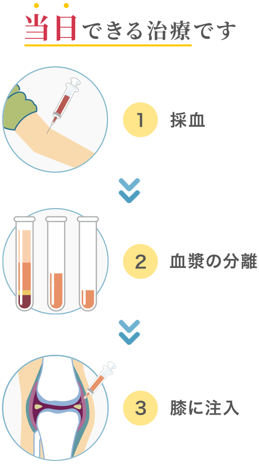 当日できる治療です/①採血→②血漿の分離→③膝に注入