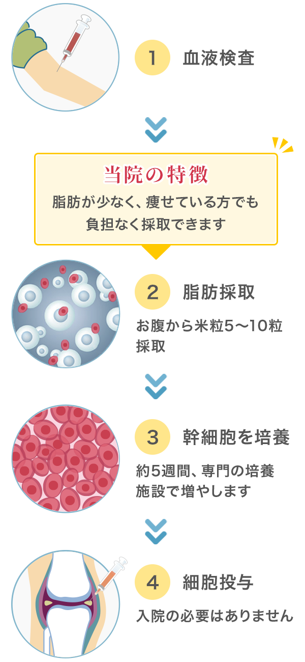 ①血液検査→②脂肪採取（お腹から米粒5〜10粒採取）【当院の特徴】脂肪が少なく、痩せている方でも負担なく採取できます→③幹細胞を培養（約5週間、専門の培養施設で増やします）→④細胞投与（入院の必要はありません）